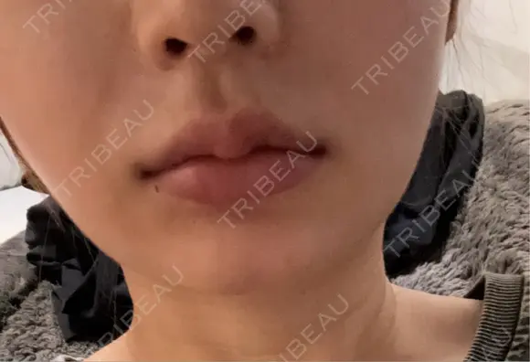 ヒアルロン酸注入（唇） ヴェリテクリニック 大阪院 DAY 0 メイン用