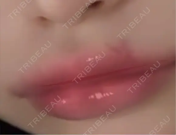 ヒアルロン酸注入（唇） ヴェリテクリニック 大阪院 DAY 1 メイン用