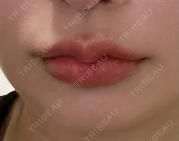 ヒアルロン酸注入（唇） ヴェリテクリニック 大阪院 AFTER メイン用