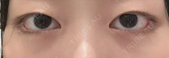 クマ治療 / 脂肪注入（目の下） R Beauty CLINIC 大阪院 AFTER メイン用