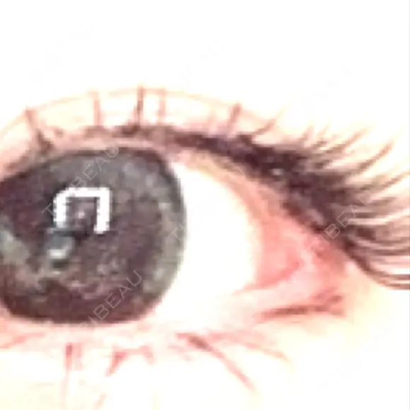 目尻切開 ヴェリテクリニック 大阪院 DAY 14 メイン用