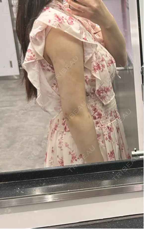 脂肪吸引（二の腕） アムルーズ美容外科クリニック 横浜院 DAY 84 メイン用