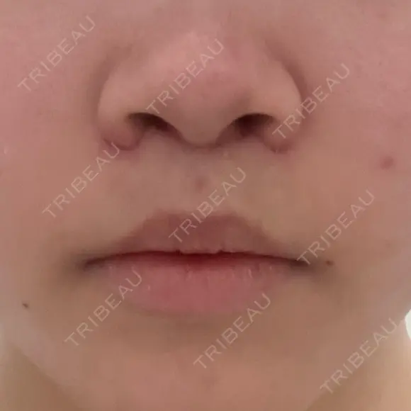 人中短縮 / 目尻切開 / タレ目形成・グラマラスライン（切開） / ボトックス（人中） / その他（鼻） ルラ美容クリニック 大阪本院 DAY 10 メイン用