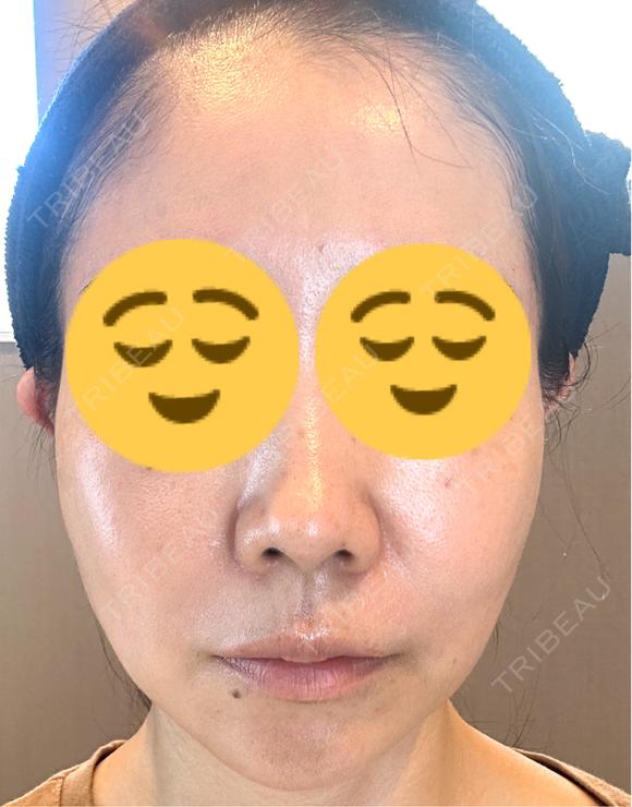 糸リフト 湘南美容クリニック 岡山院 AFTER メイン用