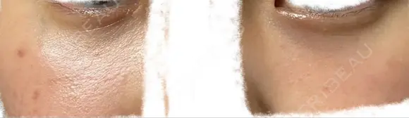 リジュラン 渋谷美容外科クリニック 横浜院 DAY 1 メイン用