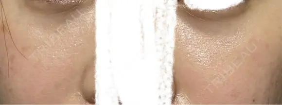 リジュラン 渋谷美容外科クリニック 横浜院 DAY 5 メイン用