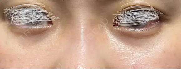 リジュラン 渋谷美容外科クリニック 横浜院 AFTER メイン用