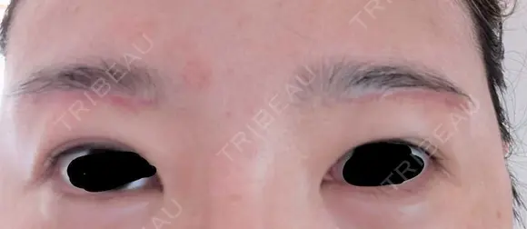 上まぶたたるみ取り / ダーマペン / 毛穴洗浄（ハイドラフェイシャルなど） Leap beauty clinic AFTER メイン用