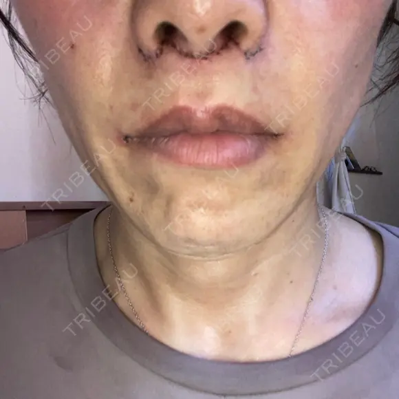 人中短縮 / 口角挙上 / その他（口元） ルラ美容クリニック 神戸院 DAY 6 メイン用