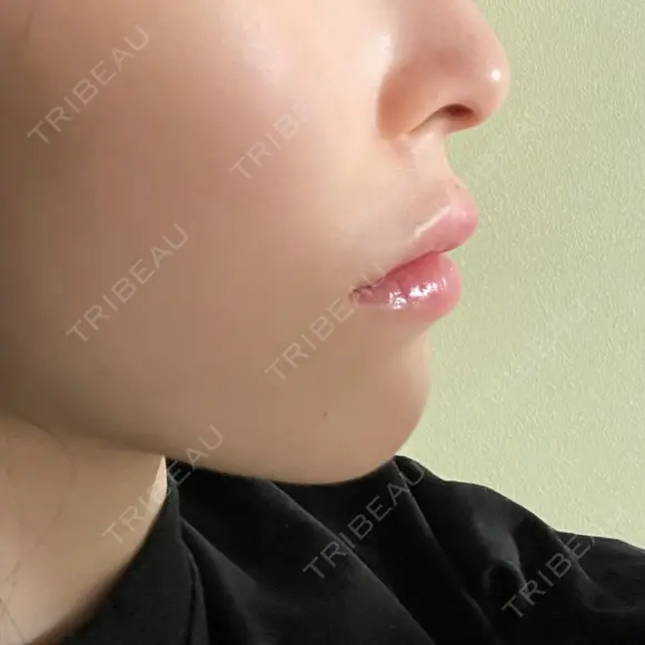 ボトックス（あご） / 肌ヒアルロン酸注入（たるみ・シワ改善） / ヒアルロン酸注入（唇） / ヒアルロン酸注入（鼻翼基部） 札幌TAクリニック DAY 0 メイン用