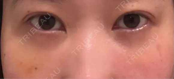 クマ治療 / 脂肪注入（目の下） 藤・ナチュレ美容クリニック 銀座院 DAY 11 メイン用