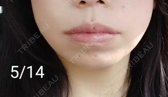 ヒアルロン酸注入（唇） Tokyo Tensei Clinic 新宿院 DAY 13 メイン用