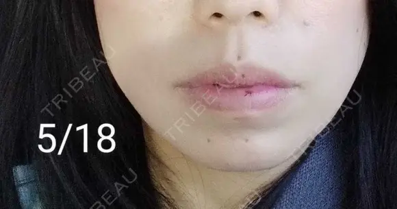 ヒアルロン酸注入（唇） Tokyo Tensei Clinic 新宿院 DAY 17 メイン用