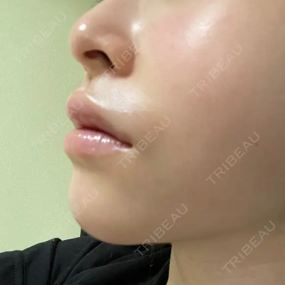 ボトックス（あご） / 肌ヒアルロン酸注入（たるみ・シワ改善） / ヒアルロン酸注入（唇） / ヒアルロン酸注入（鼻翼基部） 札幌TAクリニック DAY 1 メイン用