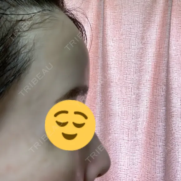 脂肪吸引（脚） / 脂肪吸引（お尻） / 脂肪注入（輪郭） Mods Clinic（モッズクリニック） 名古屋院 DAY 30 メイン用