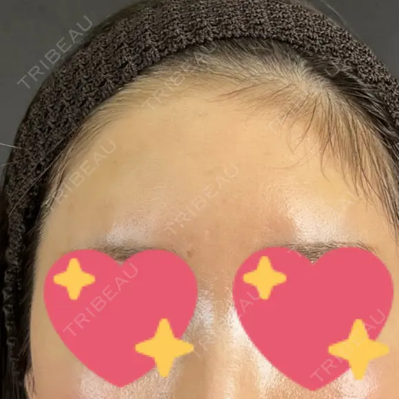 ヒアルロン酸注入（額） 藤・ナチュレ美容クリニック 銀座院 AFTER メイン用