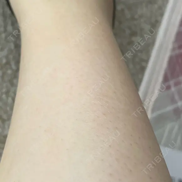 ほくろ・いぼ除去レーザー（肌） 心斎橋KT美容クリニック AFTER メイン用