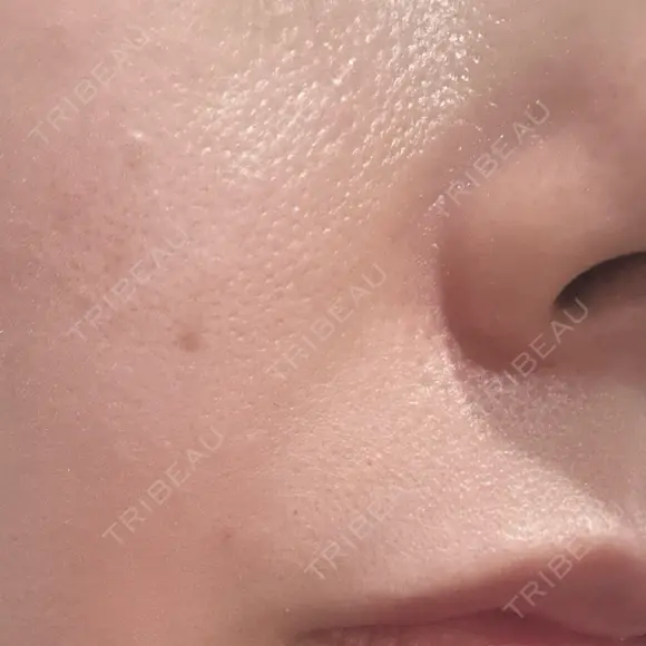 ボトックス（エラ・小顔） / その他（口元） 共立美容外科 福岡院 AFTER メイン用