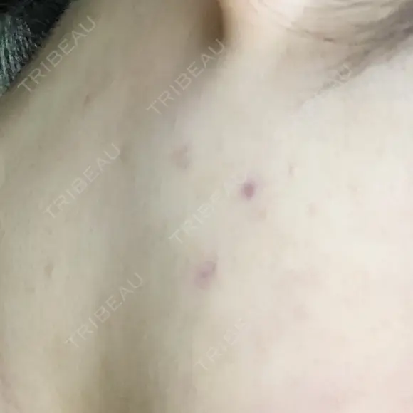 ほくろ・いぼ切除（肌） リメイ皮膚科 DAY 7 メイン用