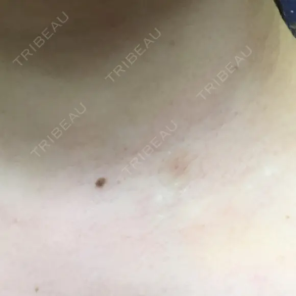 ほくろ・いぼ切除（肌） リメイ皮膚科 DAY 7 メイン用