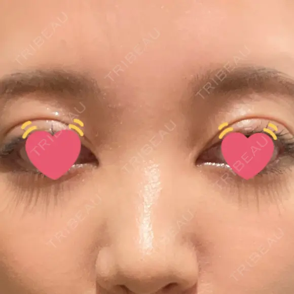 骨切幅寄せ 9BeautyClinic AFTER メイン用