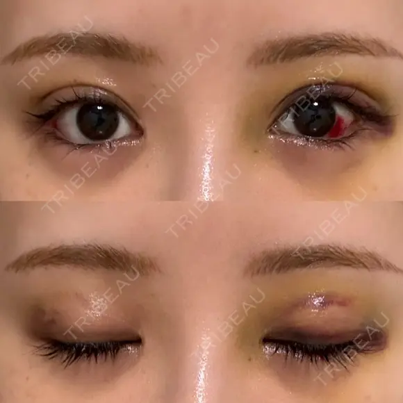 二重埋没 / 目尻切開 / 下まぶたの脂肪取り / タレ目形成・グラマラスライン（埋没） / 美容点滴・美容注射（美肌） LOUIS CLINIC 二子玉川院【ルイクリニック】 DAY 9 メイン用