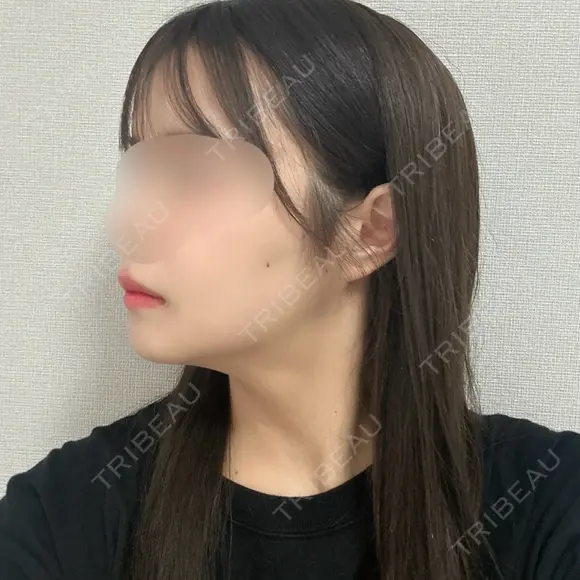 骨切り（あご） / 骨削り（エラ） / 骨削り（頬） / バッカルファット除去 / 脂肪吸引（顔） バタン美容整形外科 DAY 203 メイン用