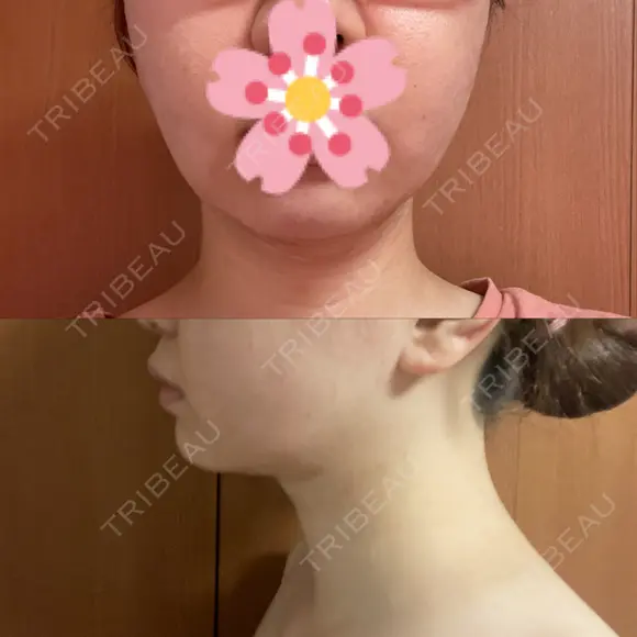 糸リフト / 脂肪吸引（顔） EMMA CLINIC（エマクリニック） DAY 31 メイン用