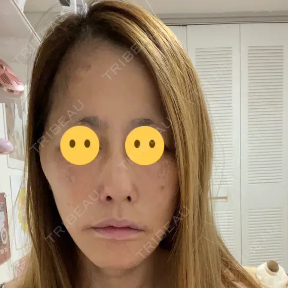 糸リフト / クマ治療 / 下まぶたの脂肪取り 湘南美容クリニック 千葉センシティ院 DAY 0 メイン用