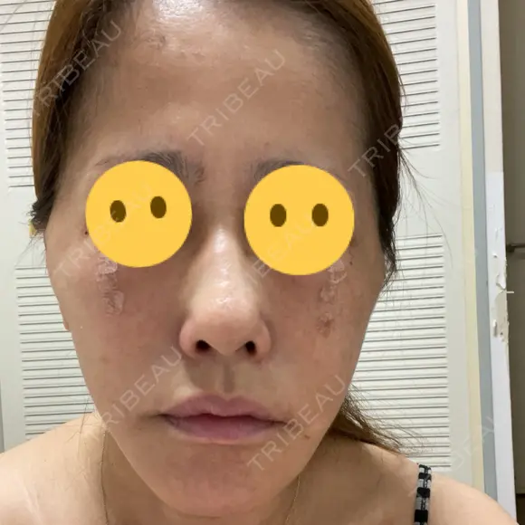 糸リフト / クマ治療 / 下まぶたの脂肪取り 湘南美容クリニック 千葉センシティ院 DAY 1 メイン用