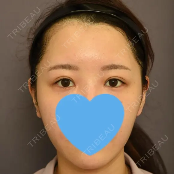 目頭切開 / 脂肪吸引（顔） / 目尻切開 / 脂肪注入（肌） / 脂肪注入（額） / 口角挙上 / メーラーファット除去 / タレ目形成・グラマラスライン（埋没） / 脂肪注入（輪郭） 札幌ル・トロワ ビューティクリニックVogue DAY 7 メイン用