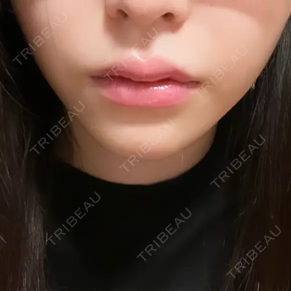 ボトックス（あご） / 肌ヒアルロン酸注入（たるみ・シワ改善） / ヒアルロン酸注入（唇） / ヒアルロン酸注入（鼻翼基部） 札幌TAクリニック AFTER メイン用