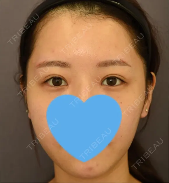 目頭切開 / 脂肪吸引（顔） / 目尻切開 / 脂肪注入（肌） / 脂肪注入（額） / 口角挙上 / メーラーファット除去 / タレ目形成・グラマラスライン（埋没） / 脂肪注入（輪郭） 札幌ル・トロワ ビューティクリニックVogue AFTER メイン用