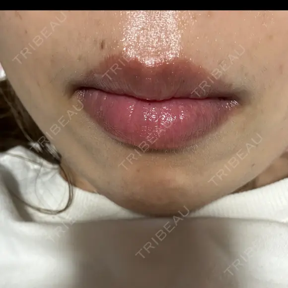 肌ヒアルロン酸注入（たるみ・シワ改善） TCB東京中央美容外科 姫路院 AFTER メイン用