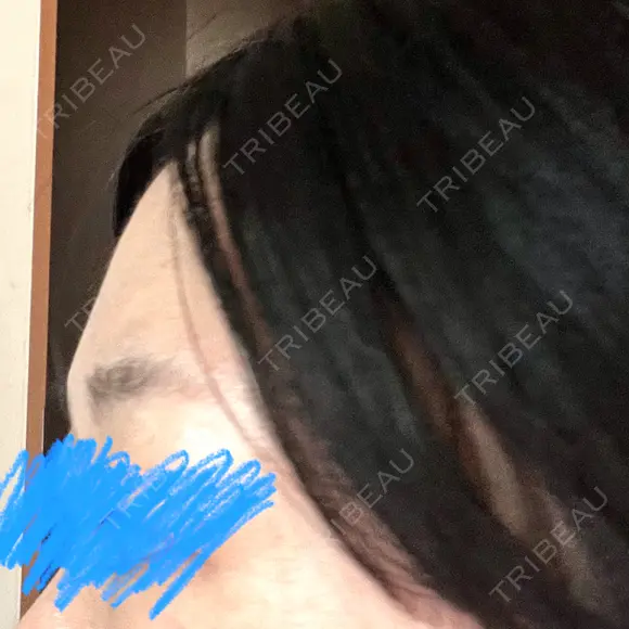 ヒアルロン酸注入（額） ヴェリテクリニック 大阪院 AFTER メイン用