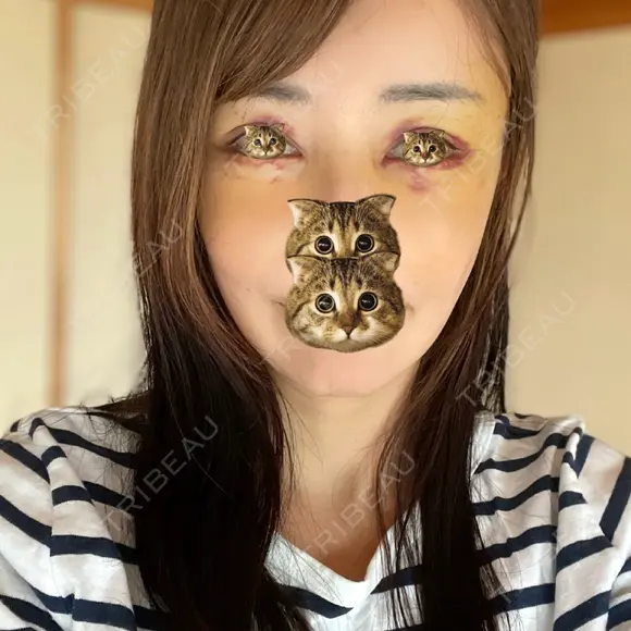 切開リフト 東京エビスクリニック DAY 5 メイン用