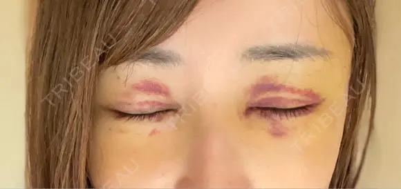 切開リフト 東京エビスクリニック DAY 5 メイン用