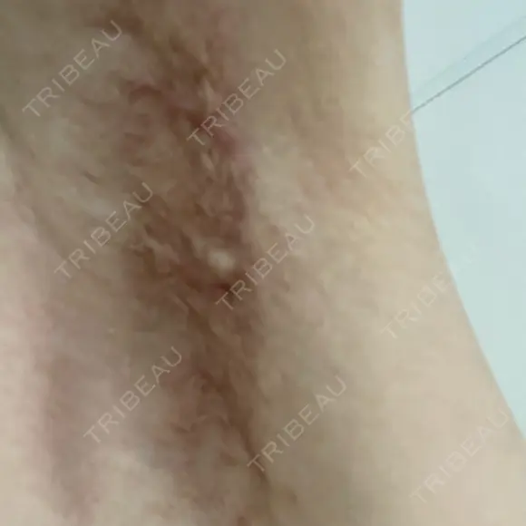 ワキ汗治療（切開） 石倉クリニック 水戸院 DAY 101 メイン用