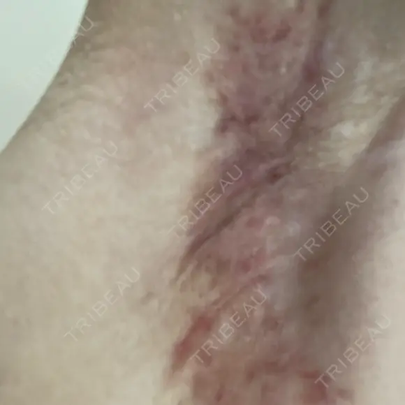 ワキ汗治療（切開） 石倉クリニック 水戸院 DAY 101 メイン用