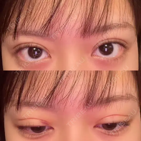 二重埋没 湘南美容クリニック 博多院 DAY 2 メイン用