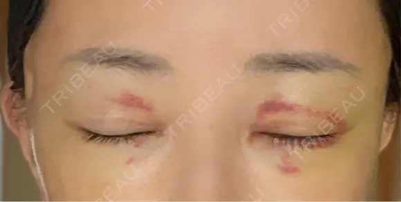 切開リフト 東京エビスクリニック DAY 7 メイン用