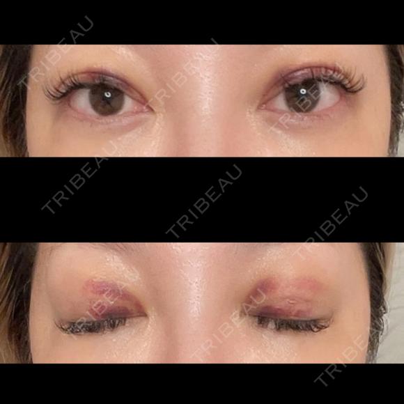 二重埋没 / 上まぶたの脂肪取り ROOTS Clinic DAY 3 メイン用