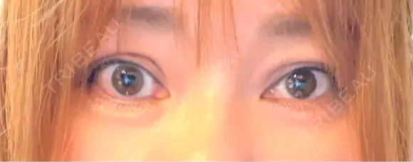 二重埋没 / 自然癒着法 東京シンデレラ美容外科 池袋院 AFTER メイン用