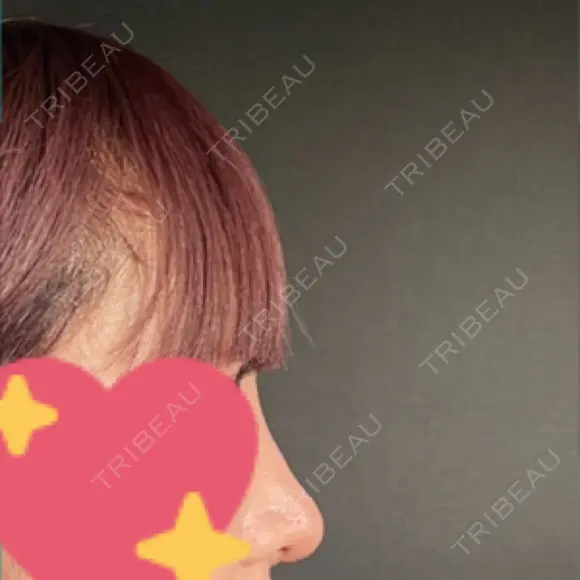 隆鼻術 / 鼻尖形成（切開） / 鼻中隔延長（切開） / 軟骨移植 R Beauty CLINIC 銀座院 AFTER メイン用