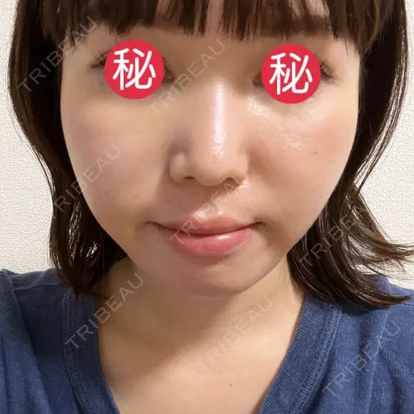 糸リフト / 脂肪吸引（顔） / メーラーファット除去 BLINC CLINIC （ブリンク クリニック） DAY 4 メイン用