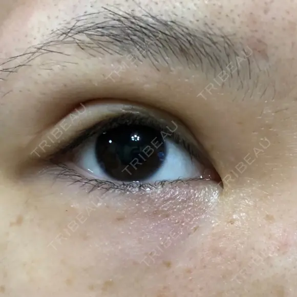 二重埋没 東京皮膚科・形成外科 (銀座いけだクリニック) DAY 3 メイン用