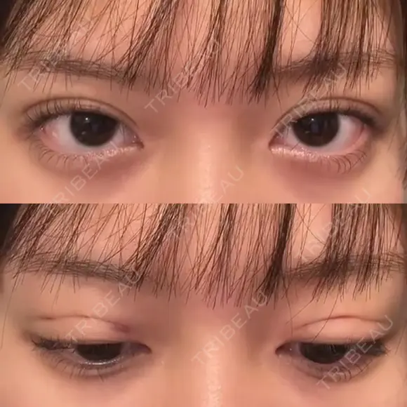 二重埋没 湘南美容クリニック 博多院 DAY 0 メイン用