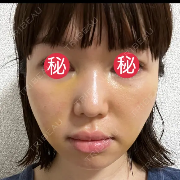 糸リフト / 脂肪吸引（顔） / メーラーファット除去 BLINC CLINIC （ブリンク クリニック） DAY 5 メイン用