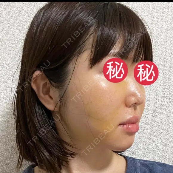 糸リフト / 脂肪吸引（顔） / メーラーファット除去 BLINC CLINIC （ブリンク クリニック） DAY 5 メイン用