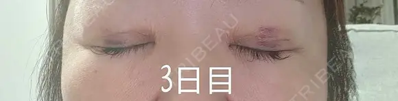 目元修正 / 自然癒着法 LUHO（ルホ）美容外科 DAY 3 メイン用